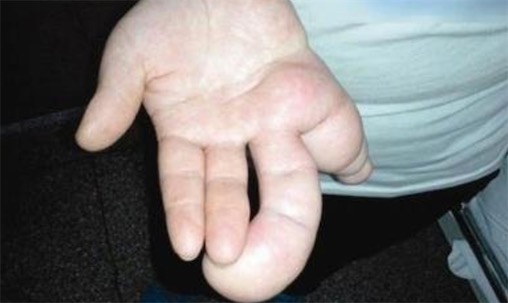 世界上最大的手 巨指病人刘华左手拇指测量长达26厘米